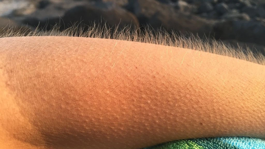 Braço com arrepios