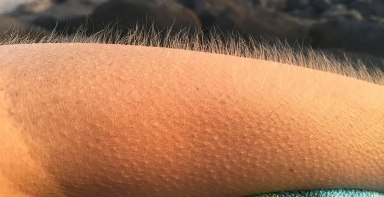 Braço com arrepios